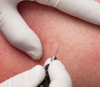 Gezielte Entfernung feiner Äderchen im Gesicht mit Onetec® Radiofrequenz-Technologie