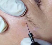 Behandlung von Pigment- und Altersflecken im Gesicht mit präziser Onetec®-Technologie