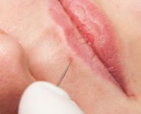 Schonende kosmetische Entfernung einer Hautveränderung im Lippenbereich