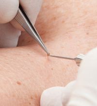 Präzise Entfernung einer Hautanomalie mit feiner Sonde während einer kosmetischen Behandlung