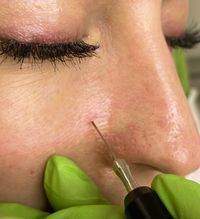 Behandlung sichtbarer Äderchen an der Nase mit Onetec® Technologie