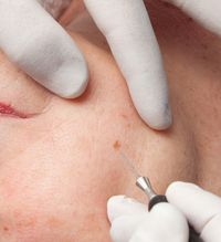 Gezielte kosmetische Entfernung eines Pigmentflecks im Gesicht