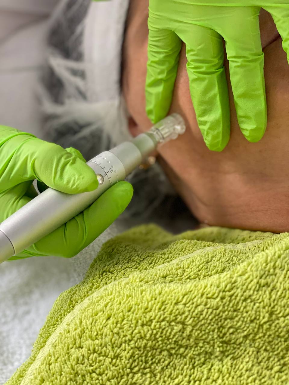 Hautneedling, auch bekannt als Microneedling